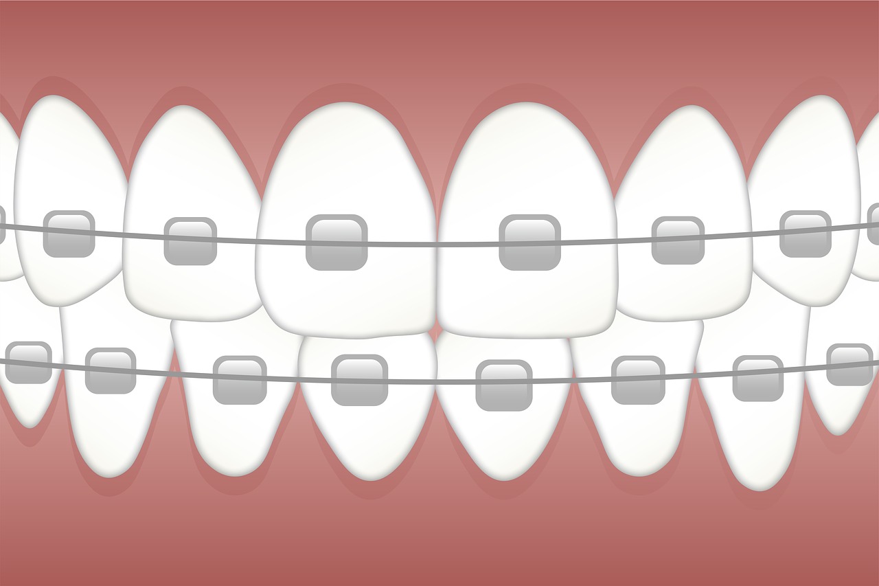Leczenie ortodontyczne. Proste zęby w każdym wieku – aparat ortodontyczny Wrocław